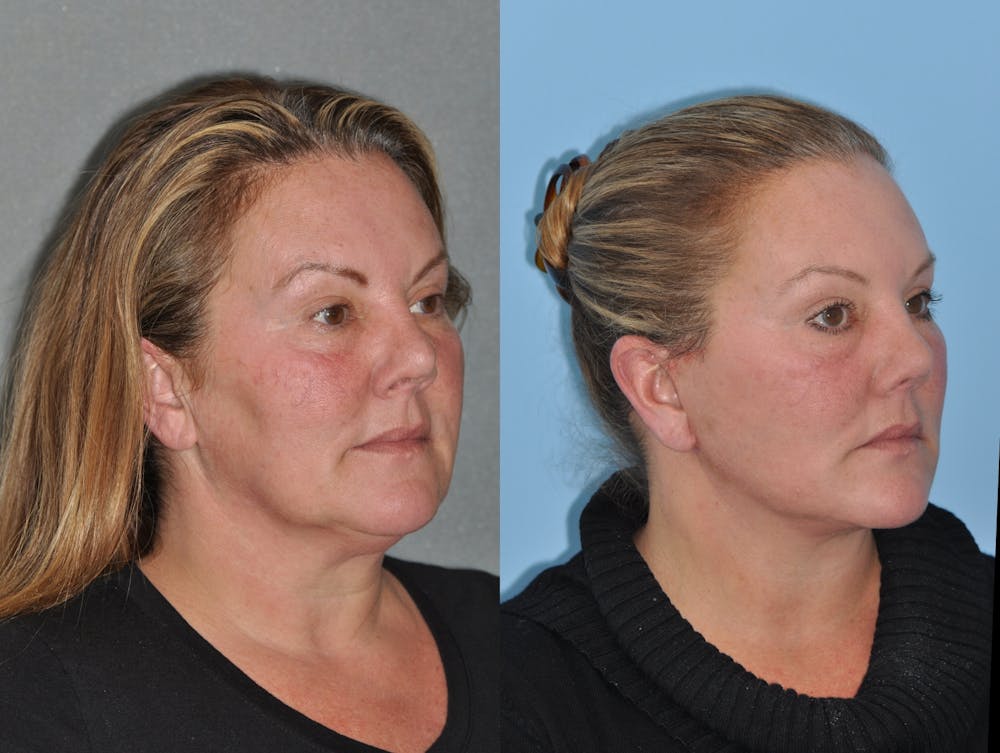 Facelift Before & After Gallery - Patient 31709468 - Image 3