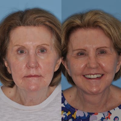 Facelift Before & After Gallery - Patient 31709470 - Image 1