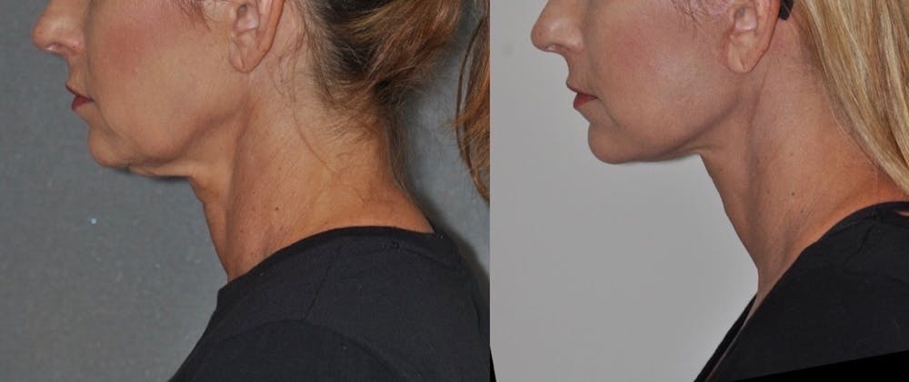 Facelift Before & After Gallery - Patient 31709467 - Image 3