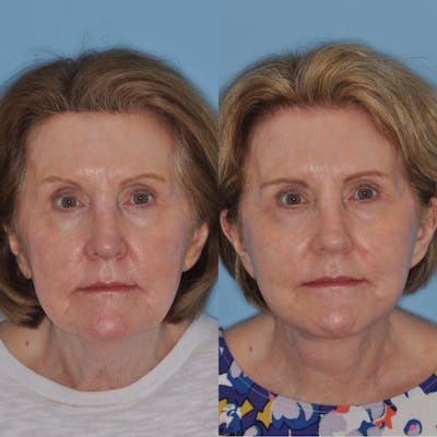 Facelift Before & After Gallery - Patient 31709470 - Image 2