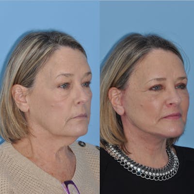 Facelift Before & After Gallery - Patient 31709471 - Image 1