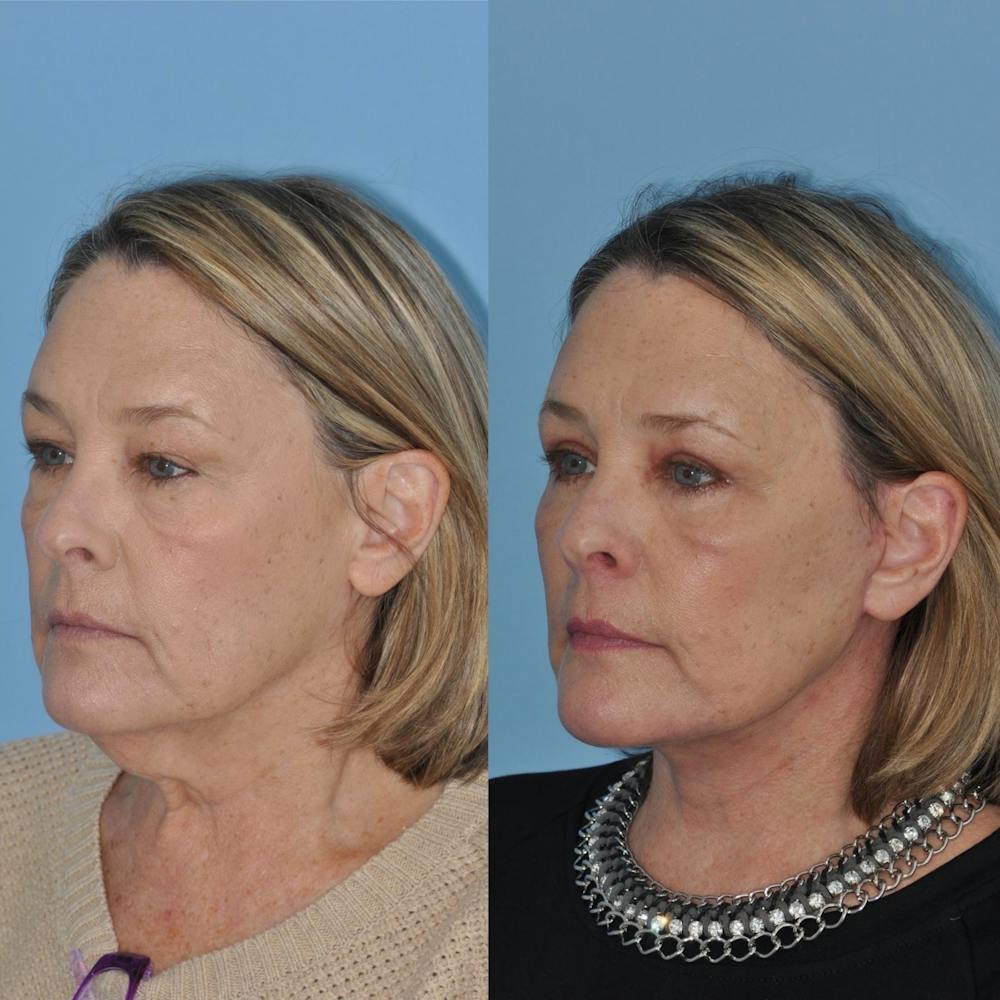 Facelift Before & After Gallery - Patient 31709471 - Image 2