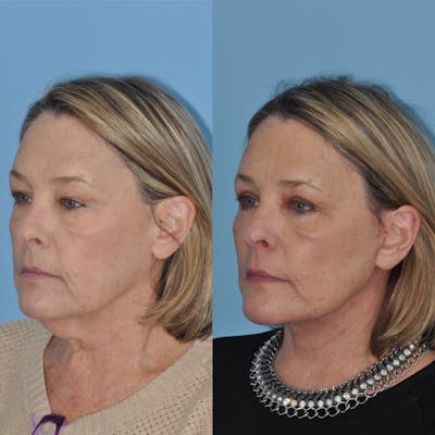 Facelift Before & After Gallery - Patient 31709471 - Image 2