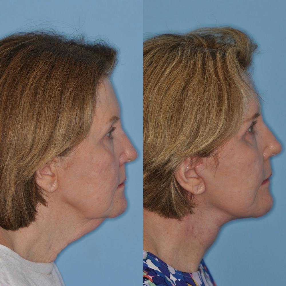 Facelift Before & After Gallery - Patient 31709470 - Image 3