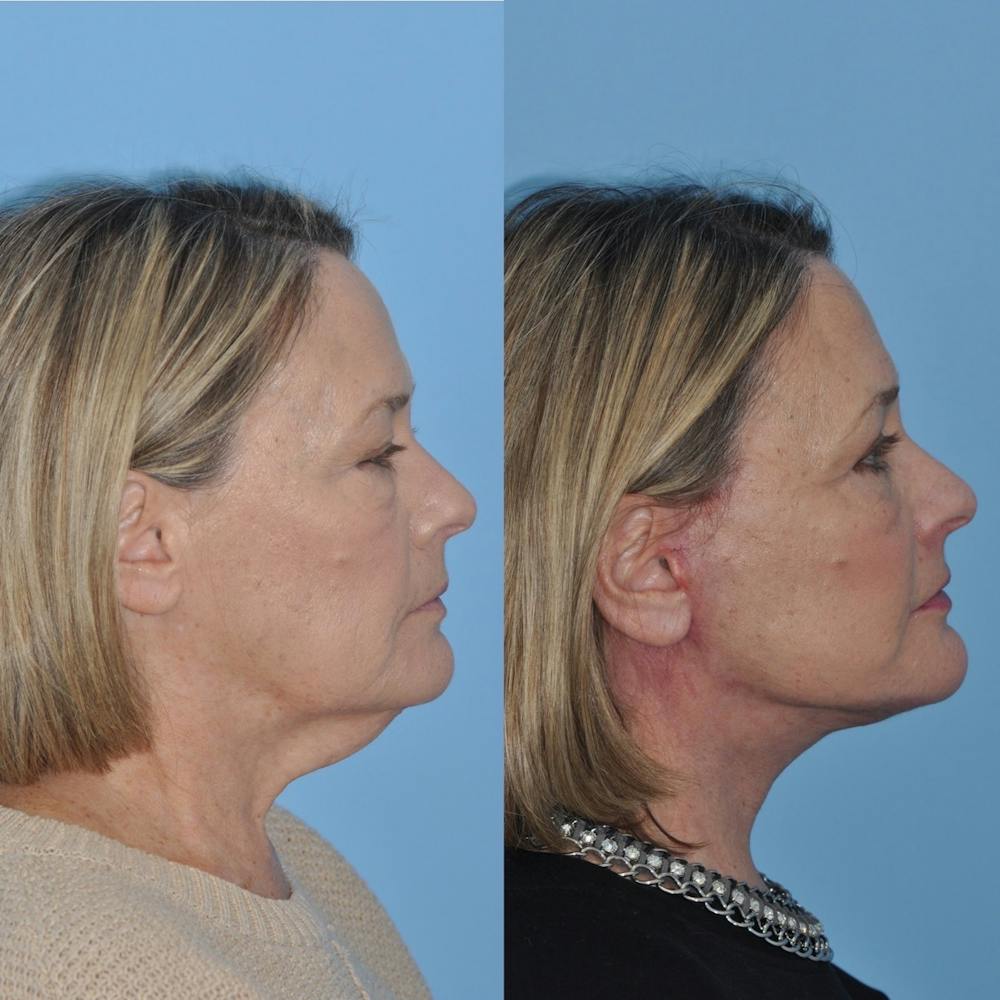 Facelift Before & After Gallery - Patient 31709471 - Image 3