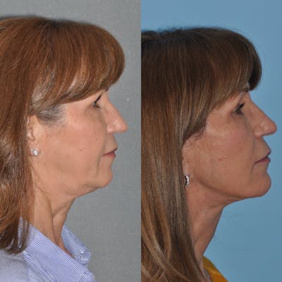 Facelift Before & After Gallery - Patient 31709472 - Image 2
