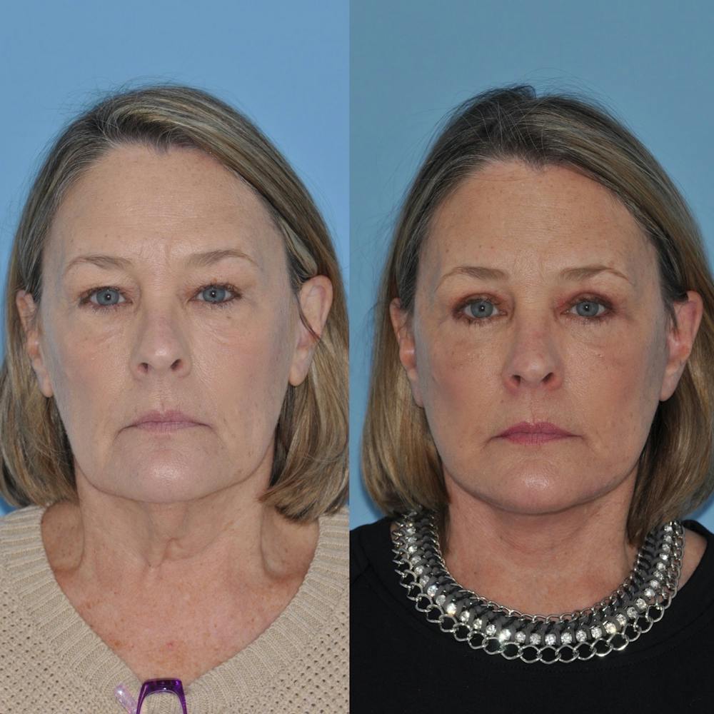 Facelift Before & After Gallery - Patient 31709471 - Image 4