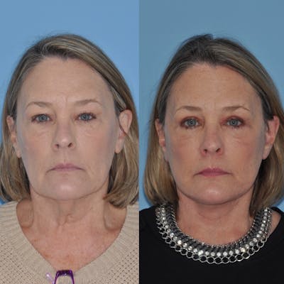 Facelift Before & After Gallery - Patient 31709471 - Image 4