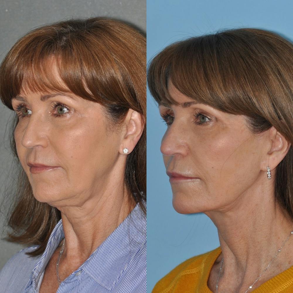 Facelift Before & After Gallery - Patient 31709472 - Image 3