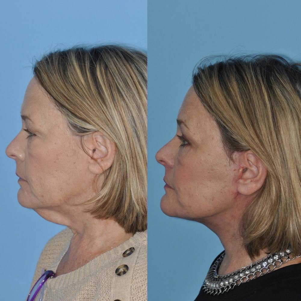 Facelift Before & After Gallery - Patient 31709471 - Image 5