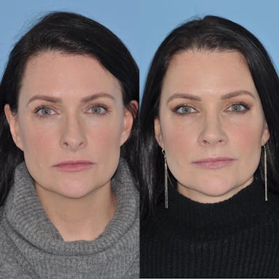 Rhinoplasty Before & After Gallery - Patient 31710038 - Image 1