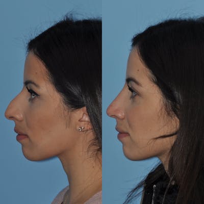 Rhinoplasty Before & After Gallery - Patient 31710040 - Image 1