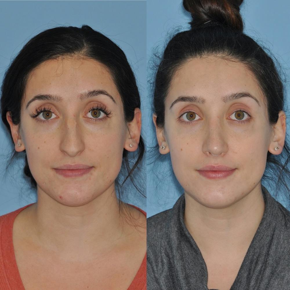 Rhinoplasty Before & After Gallery - Patient 31710039 - Image 2