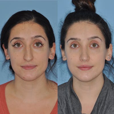 Rhinoplasty Before & After Gallery - Patient 31710039 - Image 2