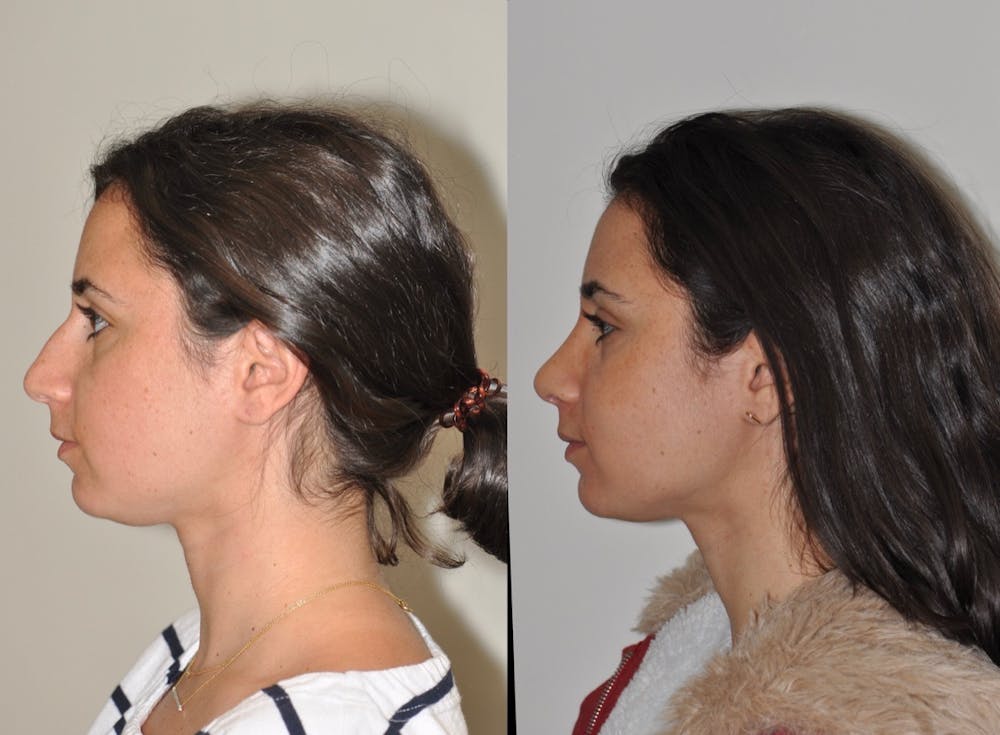 Rhinoplasty Before & After Gallery - Patient 31710041 - Image 1