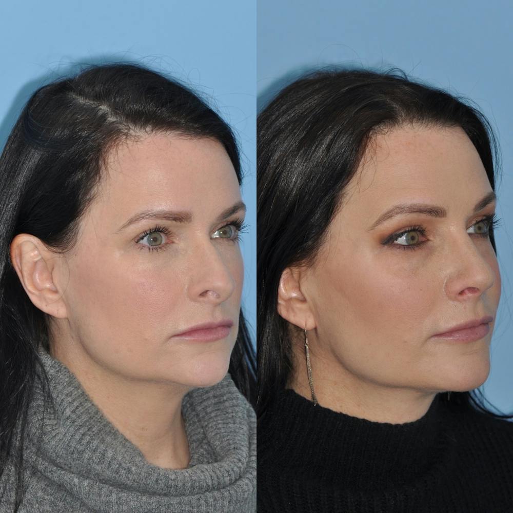 Rhinoplasty Before & After Gallery - Patient 31710038 - Image 2