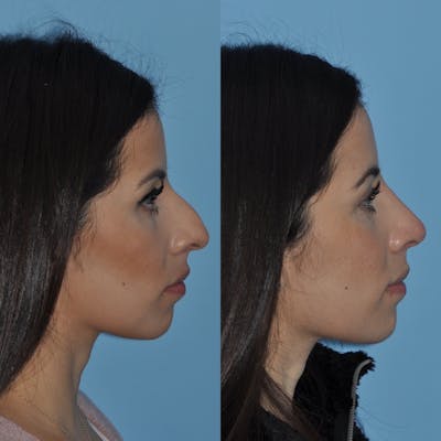 Rhinoplasty Before & After Gallery - Patient 31710040 - Image 2