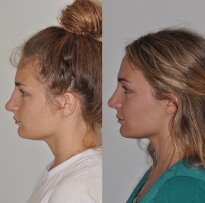 Rhinoplasty Before & After Gallery - Patient 31710042 - Image 1
