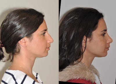 Rhinoplasty Before & After Gallery - Patient 31710041 - Image 2