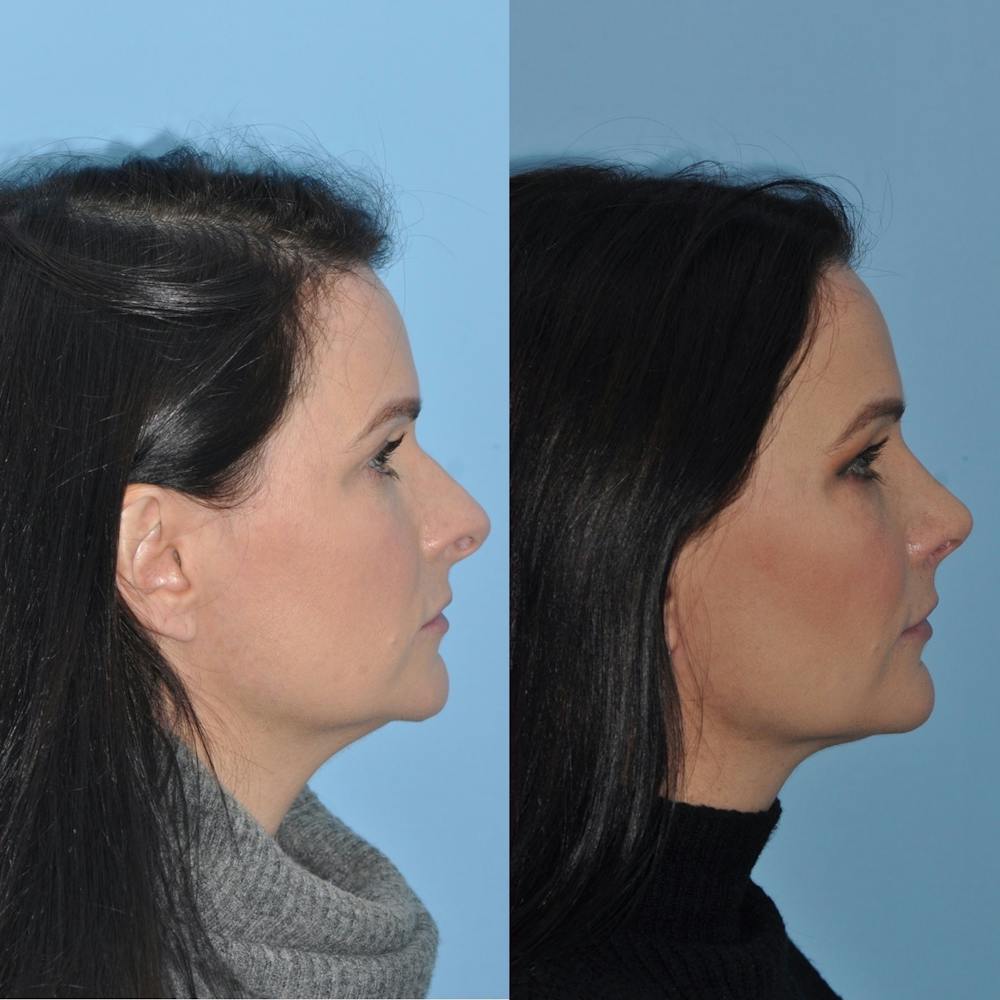 Rhinoplasty Before & After Gallery - Patient 31710038 - Image 3