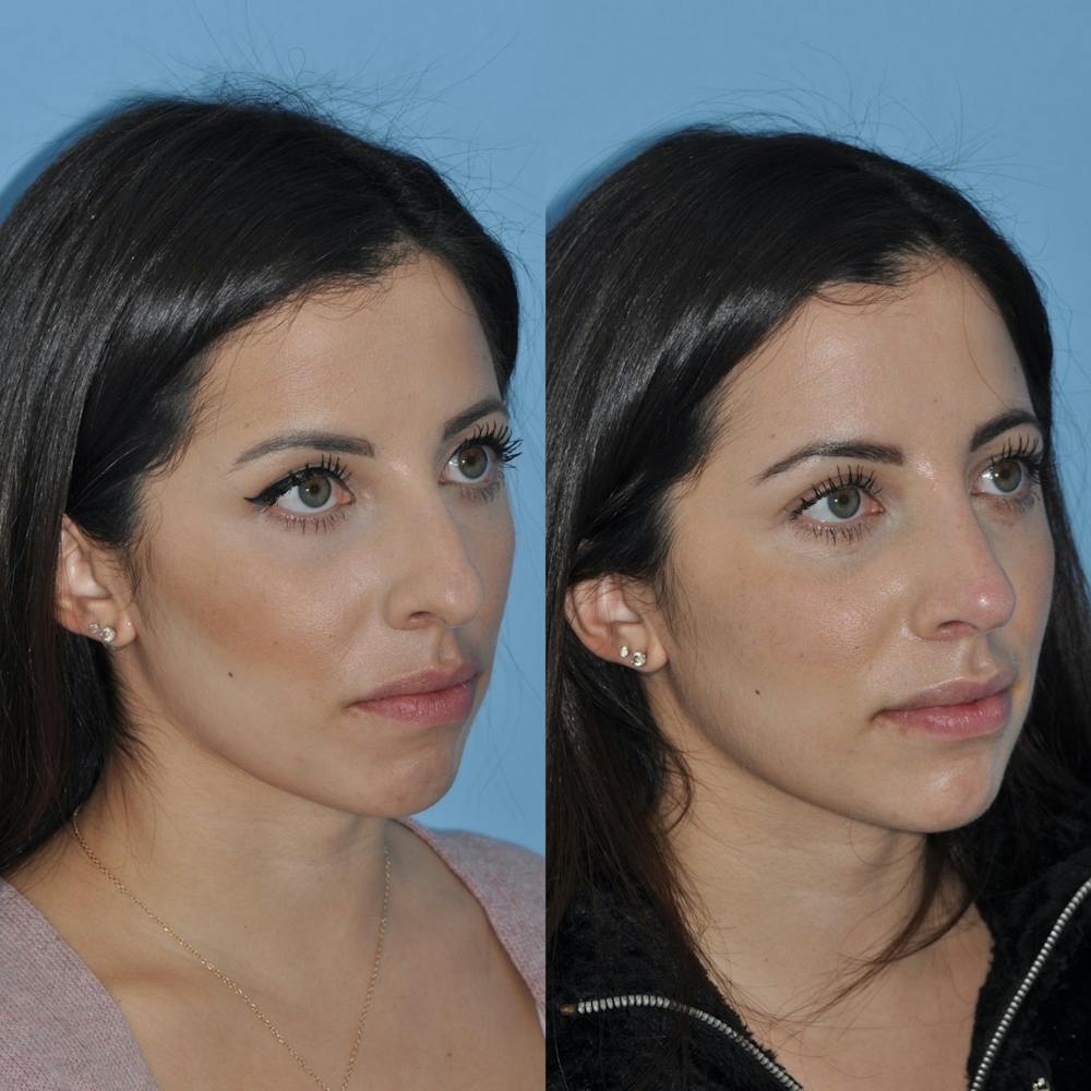 Rhinoplasty Before & After Gallery - Patient 31710040 - Image 3