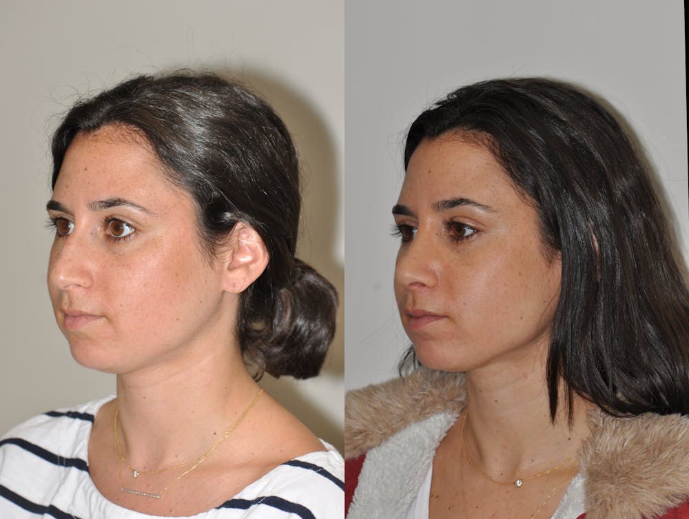 Rhinoplasty Before & After Gallery - Patient 31710041 - Image 3