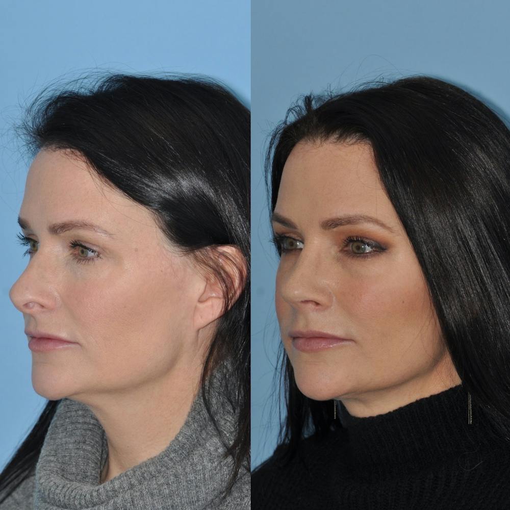 Rhinoplasty Before & After Gallery - Patient 31710038 - Image 4