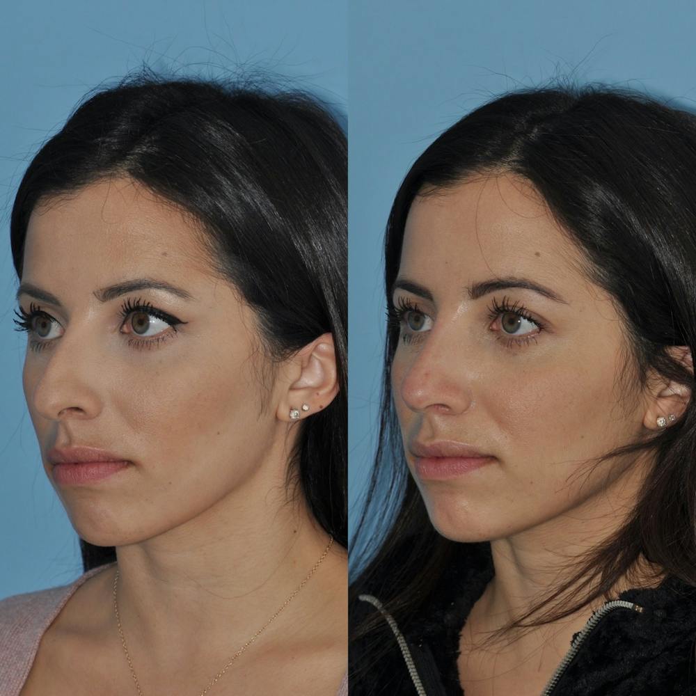 Rhinoplasty Before & After Gallery - Patient 31710040 - Image 4