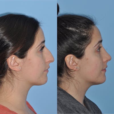 Rhinoplasty Before & After Gallery - Patient 31710039 - Image 4
