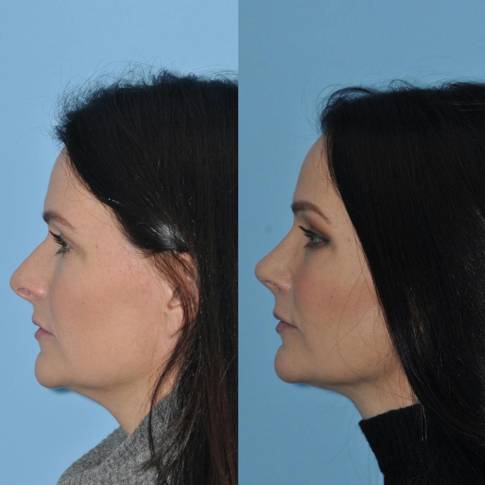 Rhinoplasty Before & After Gallery - Patient 31710038 - Image 5