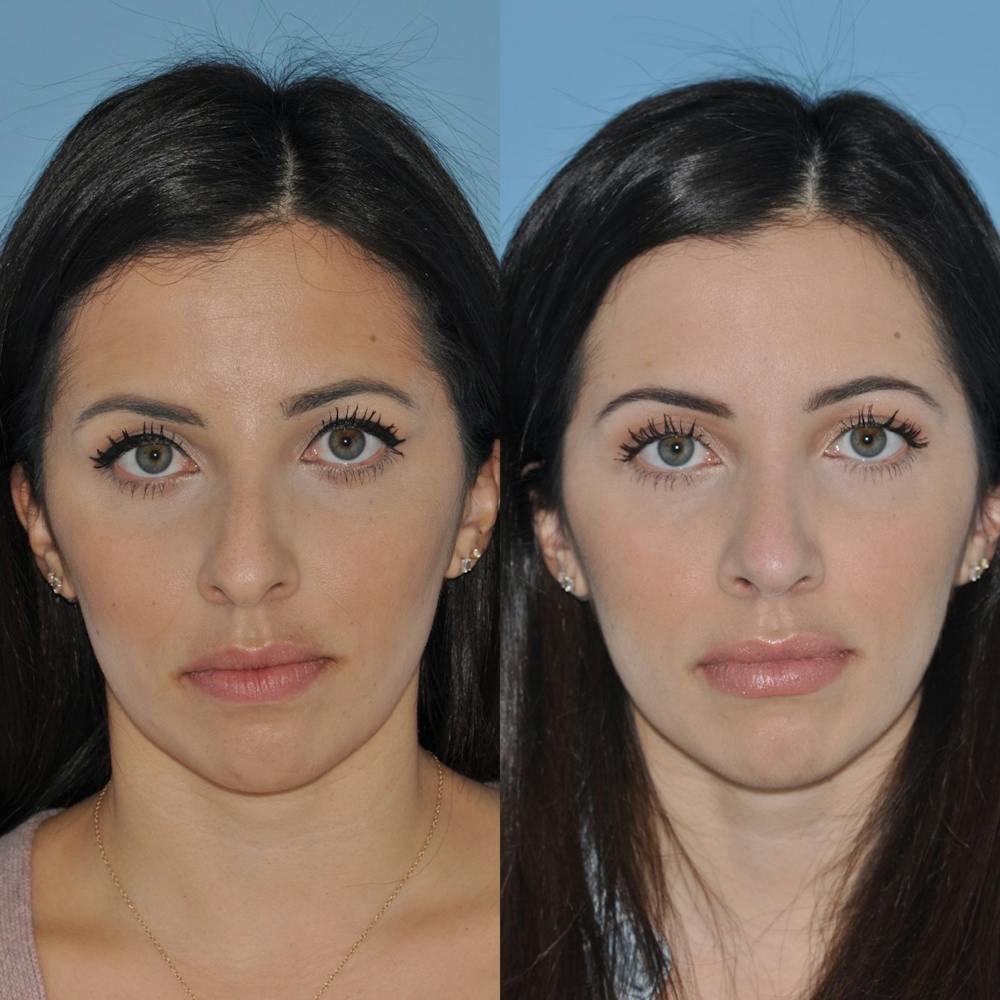 Rhinoplasty Before & After Gallery - Patient 31710040 - Image 5