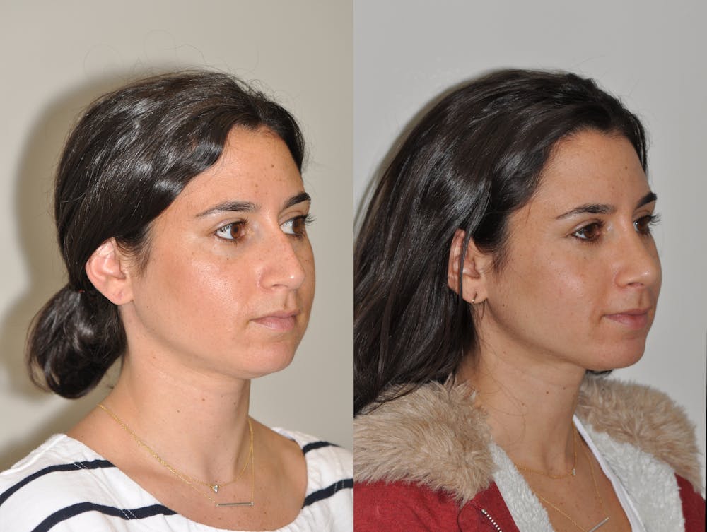 Rhinoplasty Before & After Gallery - Patient 31710041 - Image 4