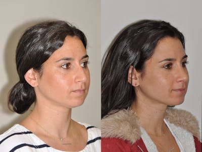 Rhinoplasty Before & After Gallery - Patient 31710041 - Image 4