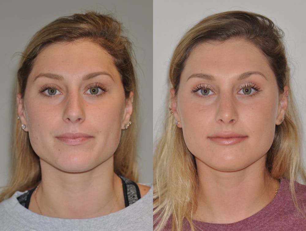 Rhinoplasty Before & After Gallery - Patient 31710043 - Image 1