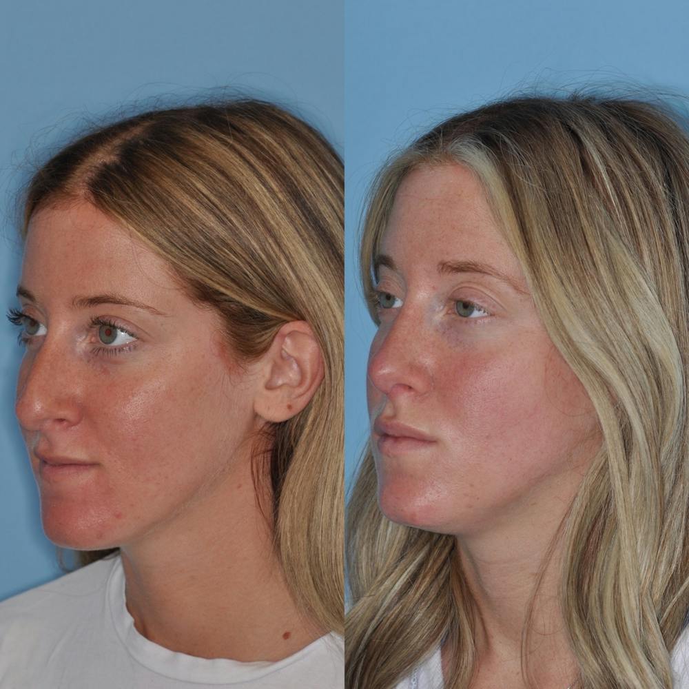Rhinoplasty Before & After Gallery - Patient 31710045 - Image 1