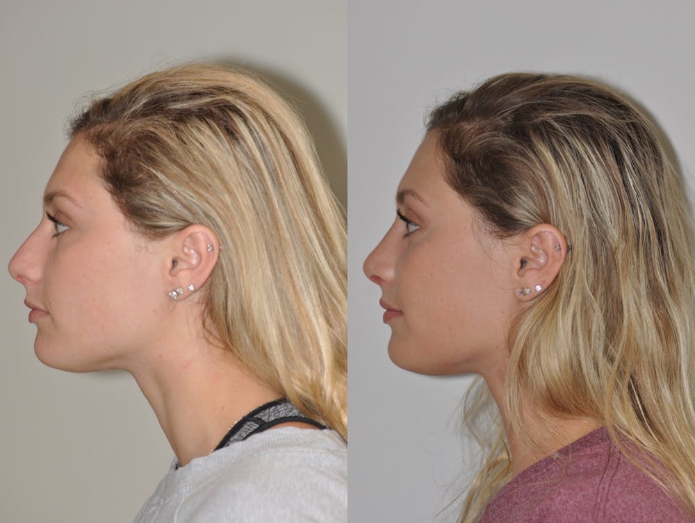 Rhinoplasty Before & After Gallery - Patient 31710043 - Image 2