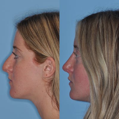 Rhinoplasty Before & After Gallery - Patient 31710045 - Image 2