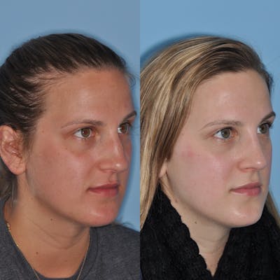 Rhinoplasty Before & After Gallery - Patient 31710047 - Image 1