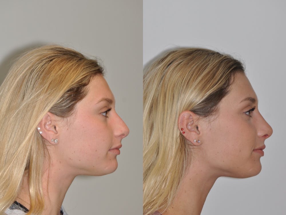 Rhinoplasty Before & After Gallery - Patient 31710043 - Image 3