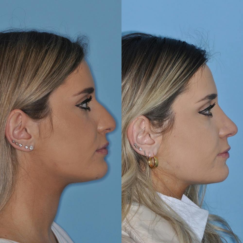Rhinoplasty Before & After Gallery - Patient 31710046 - Image 2