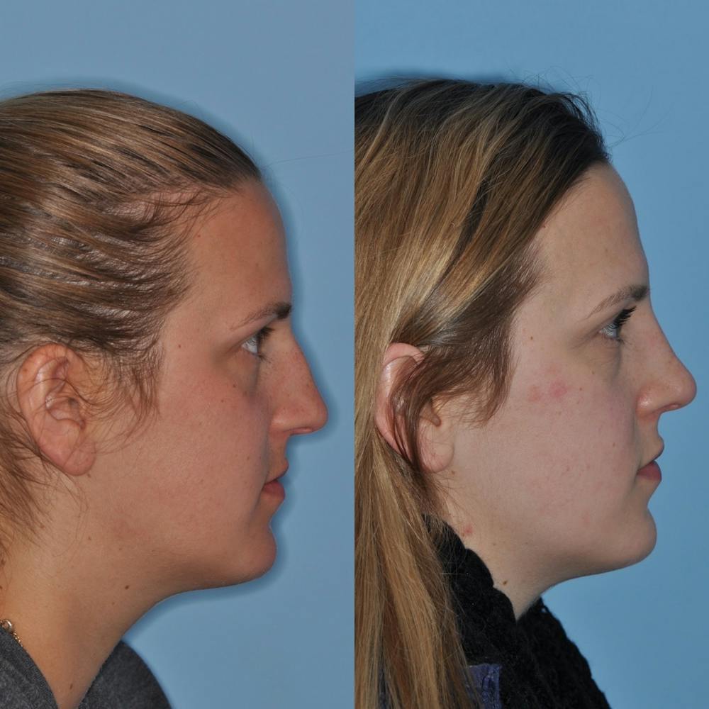 Rhinoplasty Before & After Gallery - Patient 31710047 - Image 2
