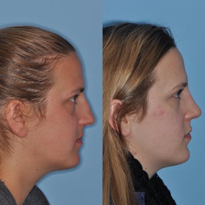 Rhinoplasty Before & After Gallery - Patient 31710047 - Image 2