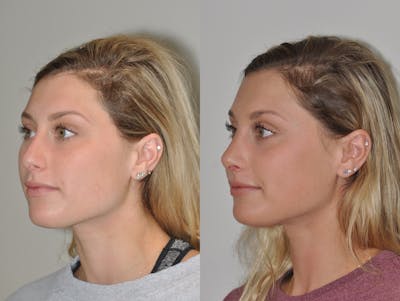 Rhinoplasty Before & After Gallery - Patient 31710043 - Image 4