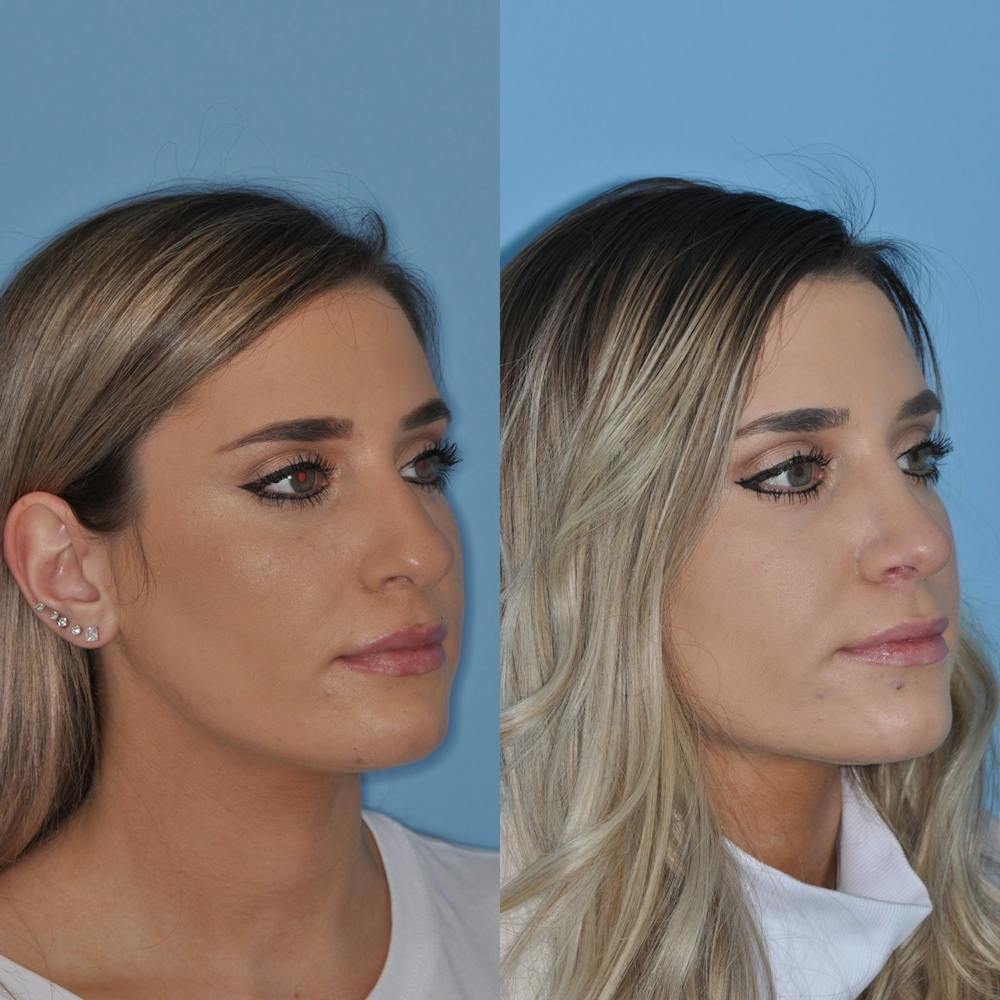Rhinoplasty Before & After Gallery - Patient 31710046 - Image 3