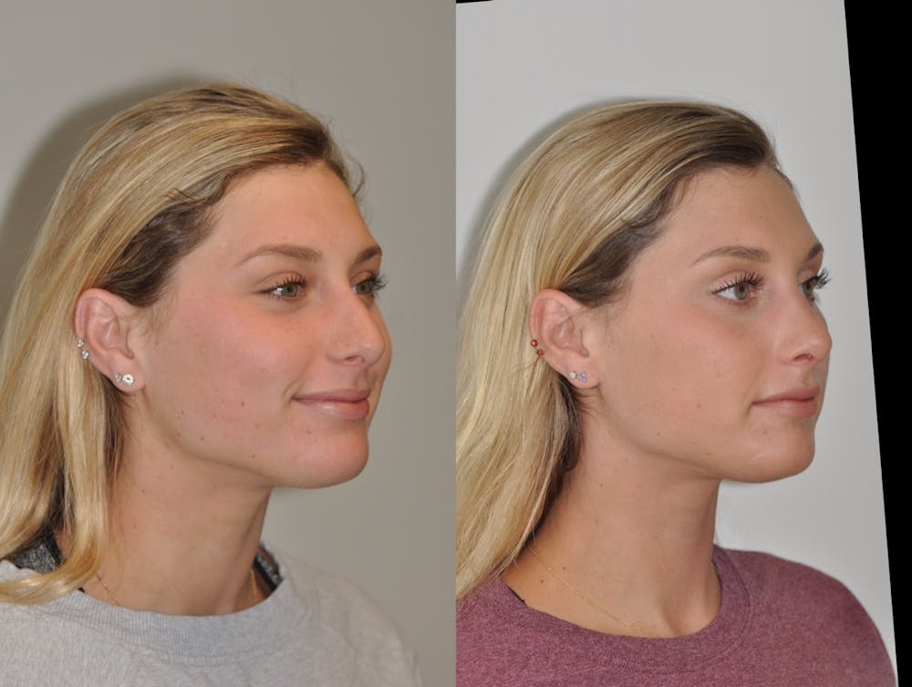 Rhinoplasty Before & After Gallery - Patient 31710043 - Image 5