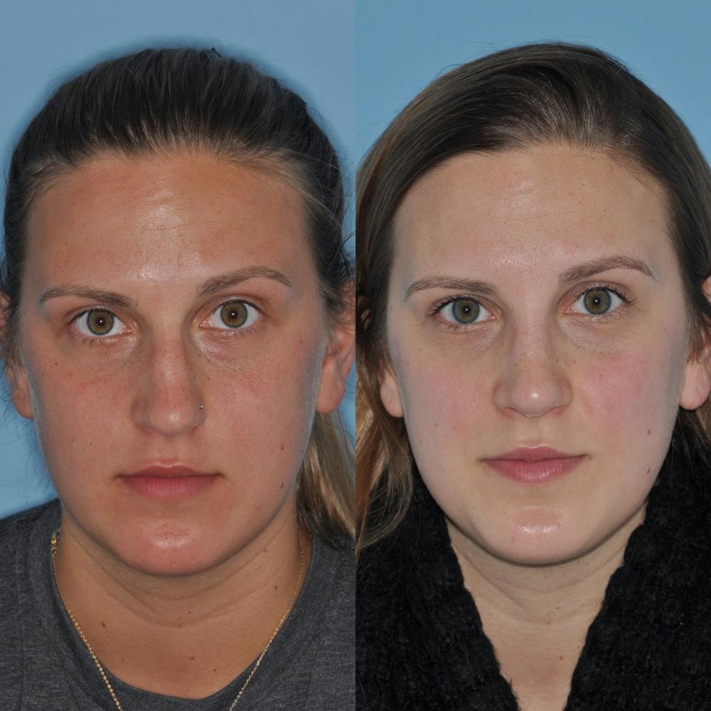 Rhinoplasty Before & After Gallery - Patient 31710047 - Image 3