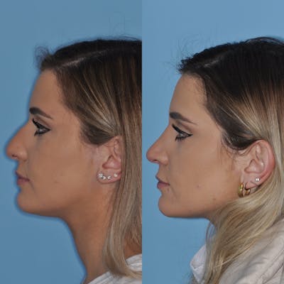 Rhinoplasty Before & After Gallery - Patient 31710046 - Image 4