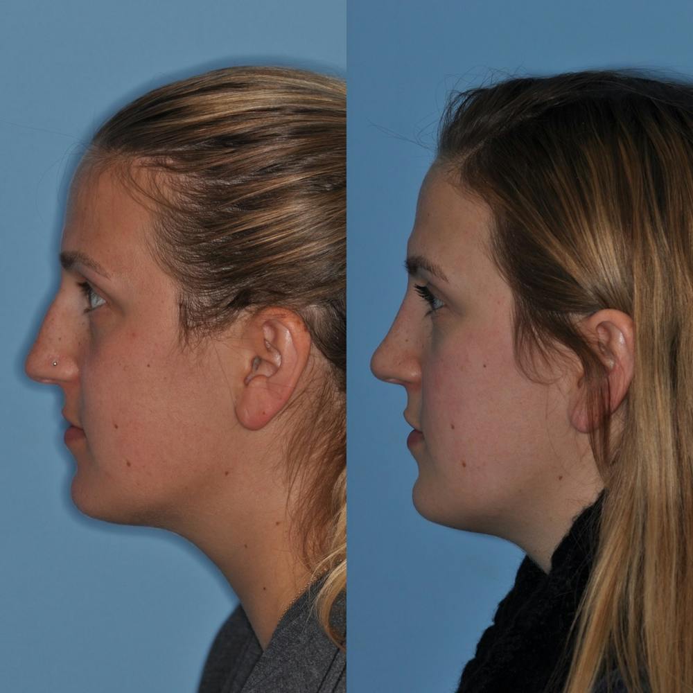 Rhinoplasty Before & After Gallery - Patient 31710047 - Image 4