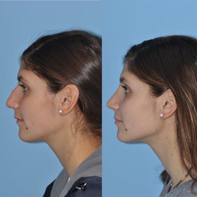 Rhinoplasty Before & After Gallery - Patient 31710048 - Image 4