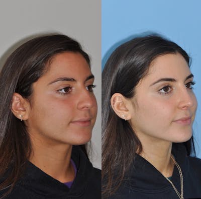 Rhinoplasty Before & After Gallery - Patient 31710049 - Image 4